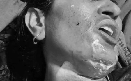 नूंह में डीजल उड़ेलकर महिला को लगाई आग:19 दिन बाद मौत,अस्पताल में तड़पते हुए गई जान,आरोपी फरार,लपटों से घिरी थी महिला