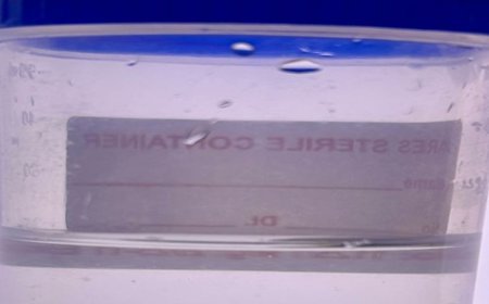 सांस नली में फंसी मूंगफली, ऑक्सीजन 40% गिरी:फरीदाबाद में दो मासूम बच्चों की मौत को डॉक्टरों ने दी मात