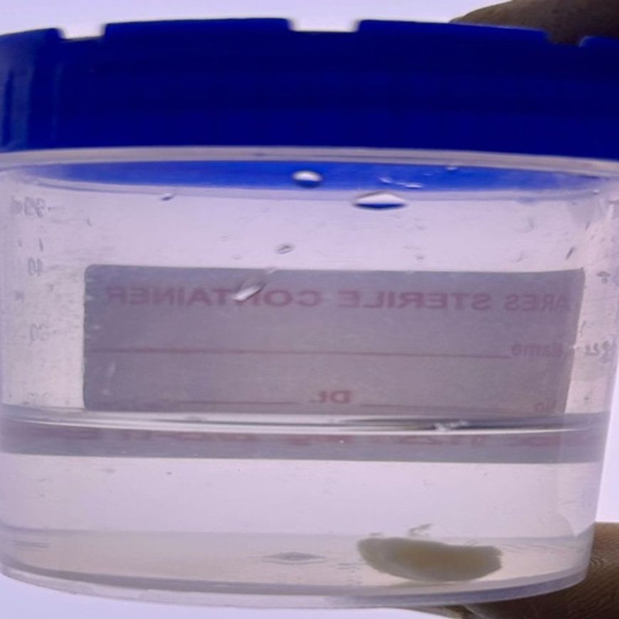 सांस नली में फंसी मूंगफली, ऑक्सीजन 40% गिरी:फरीदाबाद में दो मासूम बच्चों की मौत को डॉक्टरों ने दी मात