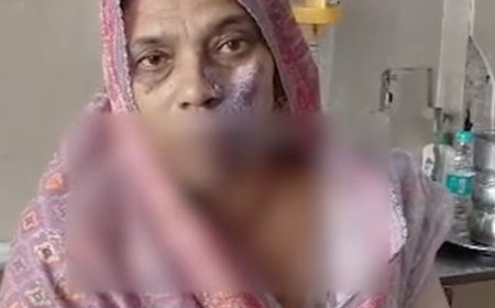 पंचकूला अस्पताल में DNB स्टूडेंट से महिला पर गिरा एसिड:निशान हटवाने आई थी, झुलस गया चेहरा, PMO ने बैठाई जांच