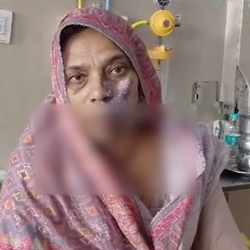 पंचकूला अस्पताल में DNB स्टूडेंट से महिला पर गिरा एसिड:निशान हटवाने आई थी, झुलस गया चेहरा, PMO ने बैठाई जांच